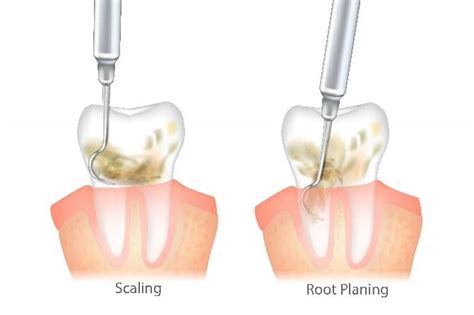 Gum Disease Scaling & Root Planing Treatment West Orange NJ