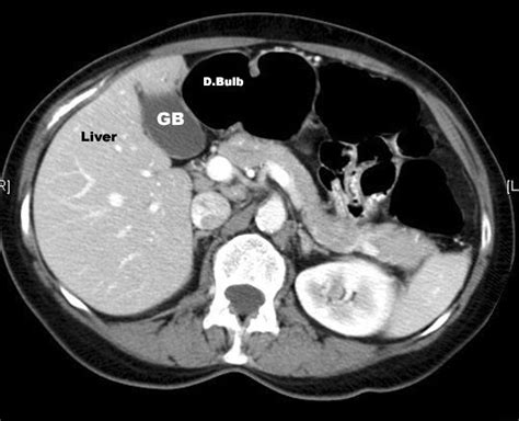 Tomografía computada del abdomen con contraste endovenoso. Observe el ...