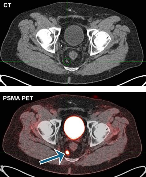 Doctors can see prostate cancer anywhere in the body with PSMA PET Imaging - UChicago Medicine