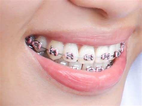 Train Track Braces Colours | What Are the Best Options?