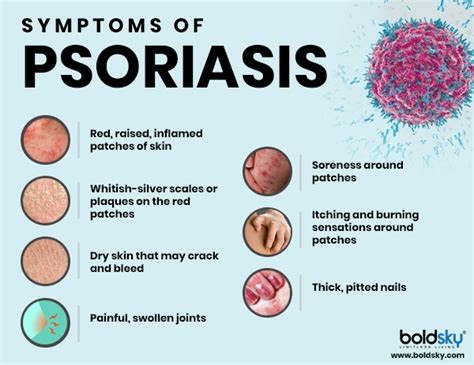 Biologics: What Are They & How They Help Treat Psoriasis - Boldsky.com