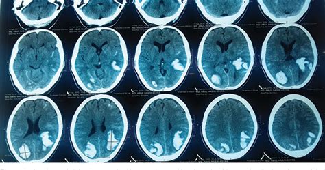 Figure 1 from Anton’s Syndrome Due to Bilateral Occipito-Parietal ...