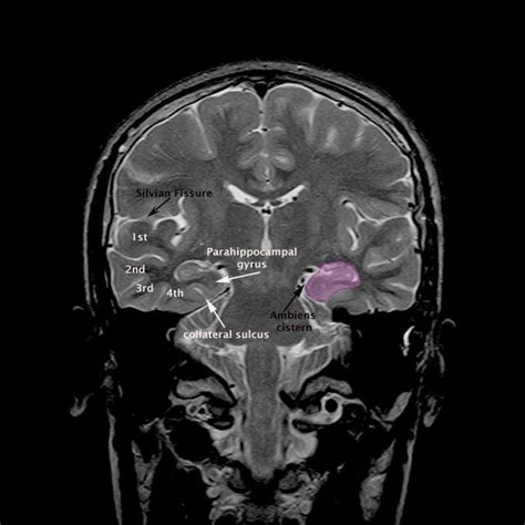 MRI Brain ambiens cistern anatomy | Radiology Anatomy Images | Mri ...