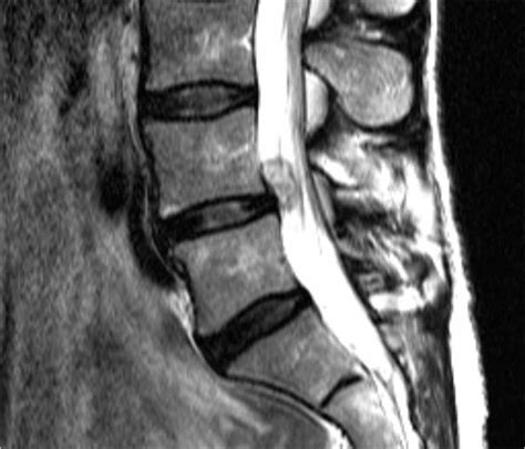 Lumbar Spine Mri Bulging Disc