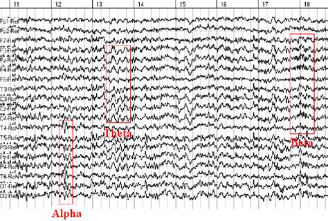 Brainwaves & EEG Example - 121 Neurofeedback Services