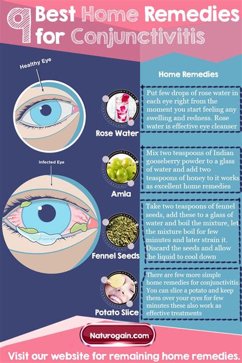 Home Remedies For Conjunctivitis | OnePronic