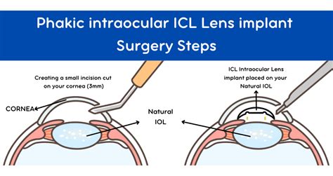 Phakic Lens Surgery - Intraocular ICL Smart Laser Eye Center