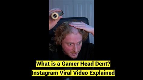 What is a Gamer Head Dent? Instagram Viral Video Explained