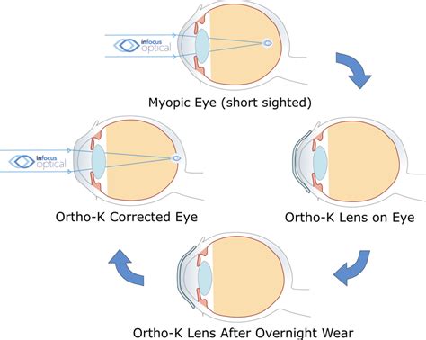 Orthokeratology (Ortho-K) | InFocus Optical