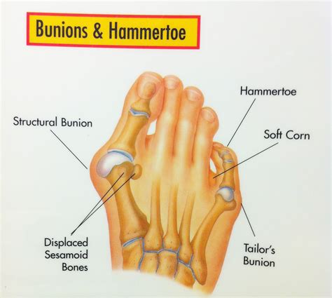 Bunions | Foot & Ankle Doctors, Inc.