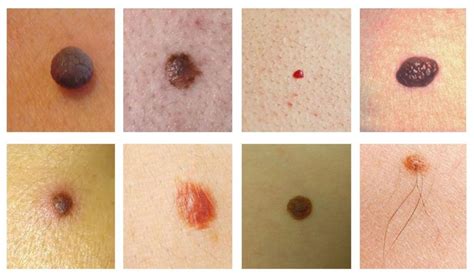 Teleconsultation for Mole Removal and Skin Cancer (Melanoma) - The Clifford Clinic