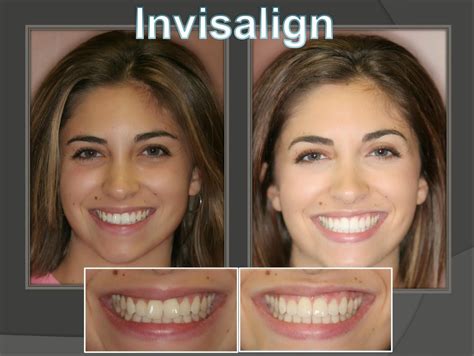 Dentist Orlando Florida: Invisalign | Invisalign, Natural transition, Orthodontics