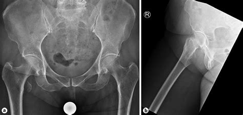 X-ray of the pelvis and lateral view of the hip showing avulsion... | Download Scientific Diagram