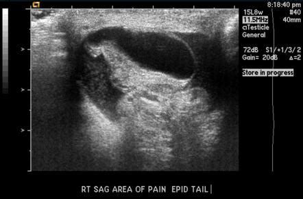 Epididymal Cyst