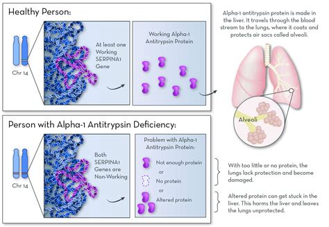 Alpha-1 Antitrypsin Deficiency