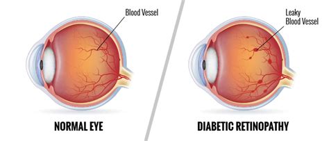 Diabetic Eye Disease – Buffalo NY | Dr. Mark Sorrentino - Family ...