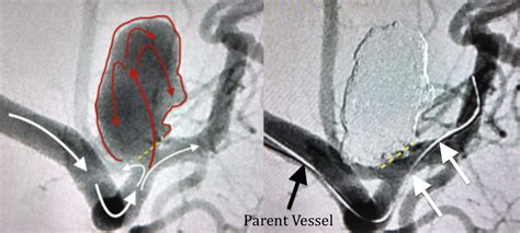 Unveiling the Power of Cerebral Angiogram