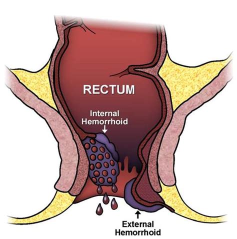 Hemorrhoids| Comprehensive Colorectal Surgery At CHI St. Vincent