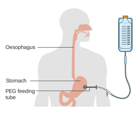 PEG Feeding Tubes - Indications and Management