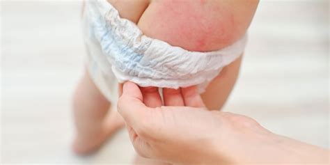 Yeast Diaper Rash: Symptoms and Treatment | HealthNews