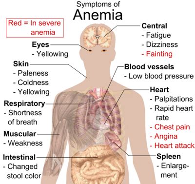 Anaemia - Physiopedia