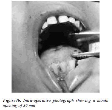 Heterotopic Calcification: A cause for Zygomatico-coronoid Ankylosis