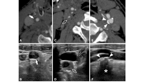 Different plaque types of the carotid artery plaques imaged using CT... | Download Scientific ...