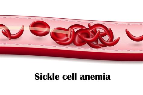 Sickle Cell Anemia- Symptoms, Treatment Options, Causes & More