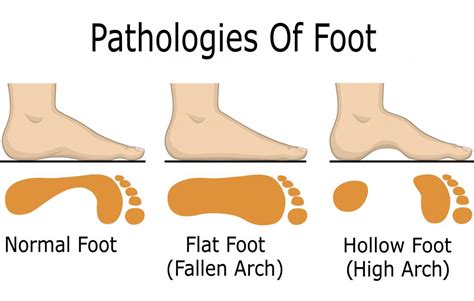 Overpronation: Causes, treatment, and exercises (2022)