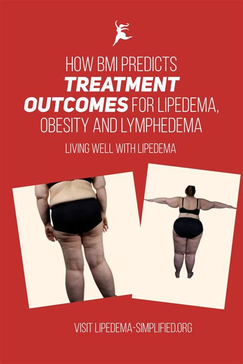 Pin by Lipedema Simplified on Treatment for Lipedema and Lymphedema in 2021 | Lymphedema ...