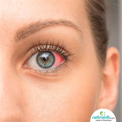 Red Spot On Eye: Causes, Symptoms And Treatment | Netmeds