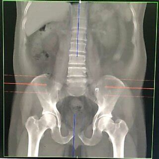 Simulated anteroposterior pelvic radiograph in the anterior pelvic plane | Download Scientific ...