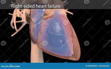 Right sided heart failure stock illustration. Illustration of ...