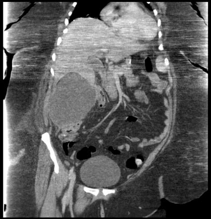 Abdominal Abscess Drainage