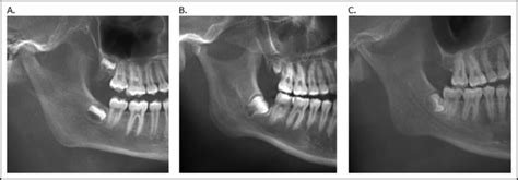 Idiopathic condylar resorptions: 3-dimensional condylar bony deformation, signs and symptoms ...