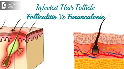 Infected hair follicle. What to do? Causes, Location, & Treatment-Dr. Rasya Dixit | Doctors ...