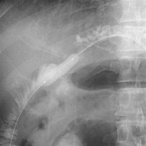 Schema of Roux-en-Y hepaticojejunostomy and EUS-guided approach to the... | Download Scientific ...