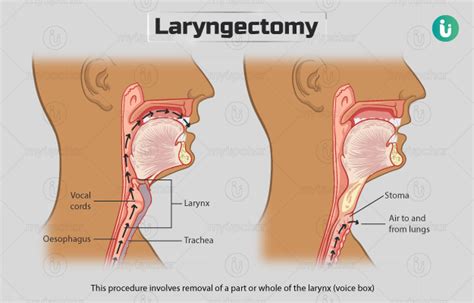 Laryngectomy: Procedure, Purpose, Results, Cost, Price