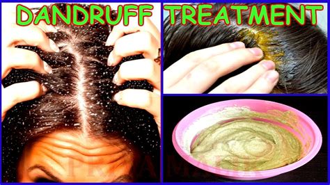 10+ What Causes Dandruff In Hair Images - onurcanaydogmus