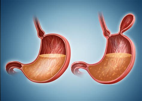 Bowel Obstruction: Symptoms, Causes, Diagnosis, and Treatment