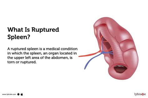 Ruptured spleen: Causes, Symptoms, Treatment and Cost