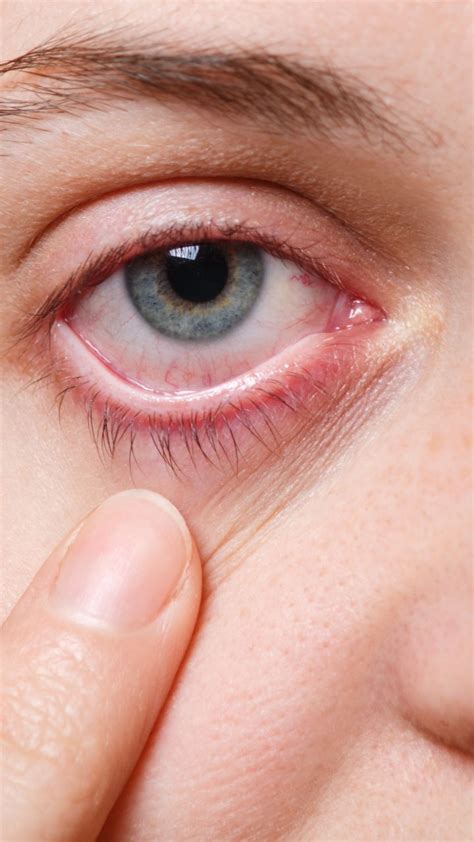 Understanding Eye Flu: Causes, Types, Symptoms, Treatment and Effective ...