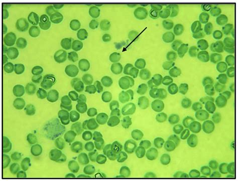 Heinz bodies (arrow) in the blood smear. Blu cresile stain, ×100... | Download Scientific Diagram