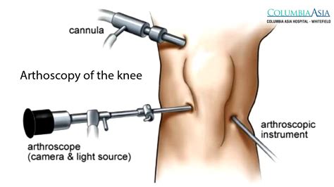 How long does it take to recover from Arthroscopic Knee Surgery? - YouTube