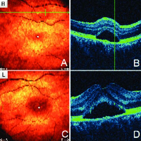 Optical coherence tomography (OCT) horizontal scans of both maculae... | Download Scientific Diagram