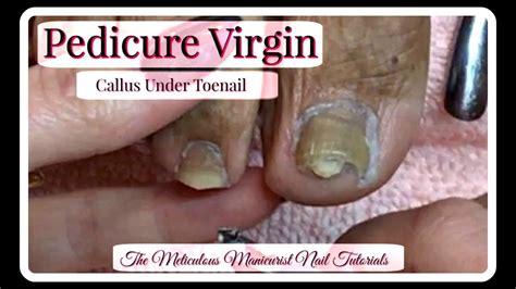 What Causes Thick Toenails - Nail Ftempo