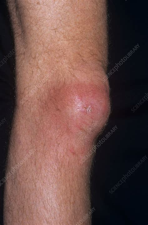 Bursitis of the knee - Stock Image - M120/0145 - Science Photo Library