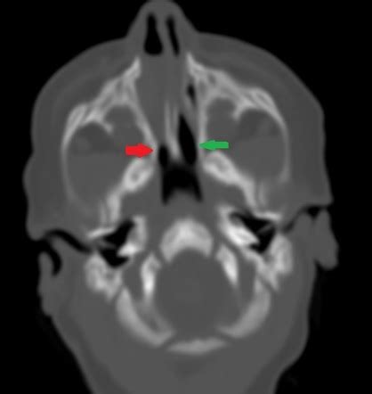 Unilateral choanal atresia | Radiology Case | Radiopaedia.org