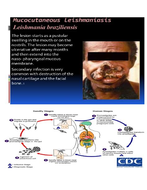 Mucocutaneous leishmaniasis - 3 Distribution At present 90 % of all mucocutaneous leishmaniasis ...