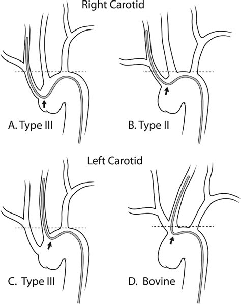 Aortic Arch Anatomy